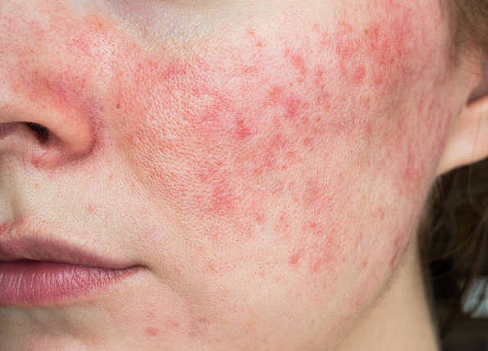 Gentle Skincare for Sensitive Skin