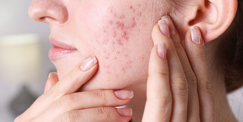 The Science Behind Effective Acne Treatment: Decoding Strategies for Clear, Healthy Skin