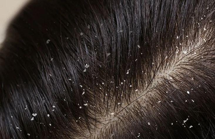 Best Anti-Dandruff Products & Dry Scalp Solutions