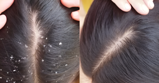 Top Anti-Dandruff Treatments for a Flake-Free Scalp