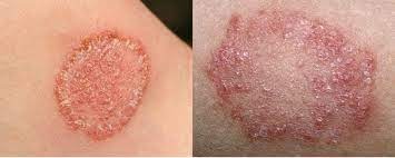 Effective Antifungal Treatments for Healthy Skin and Nails