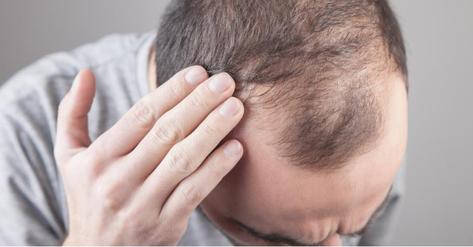 Hair Fall: A Doctor’s Guide for Indian Patients pic